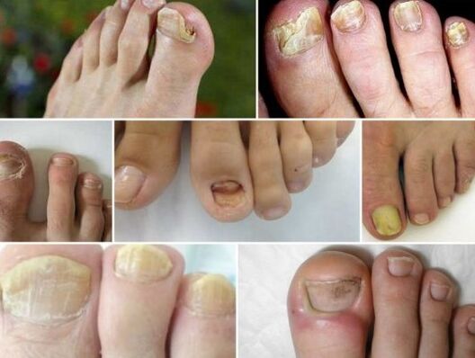 Different forms of nail fungus