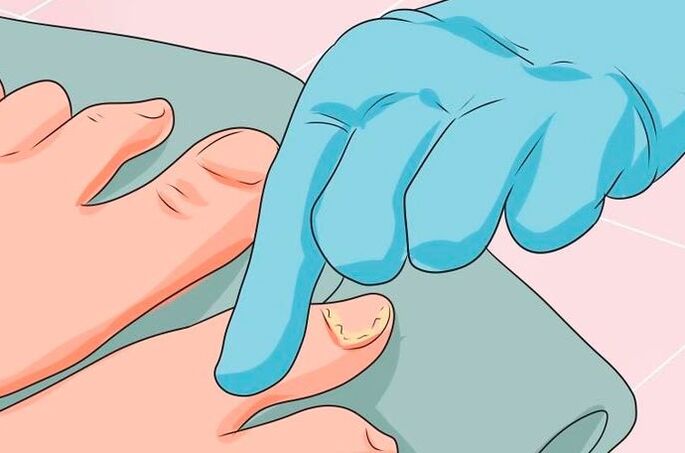 First signs of nail micose