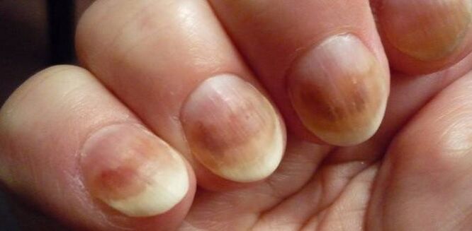 Infection with micoses of nails