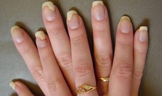 Nail fungus is what is visible in the process of operational