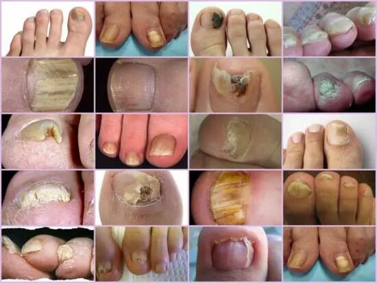 Onicomycosis of different localization in the nail