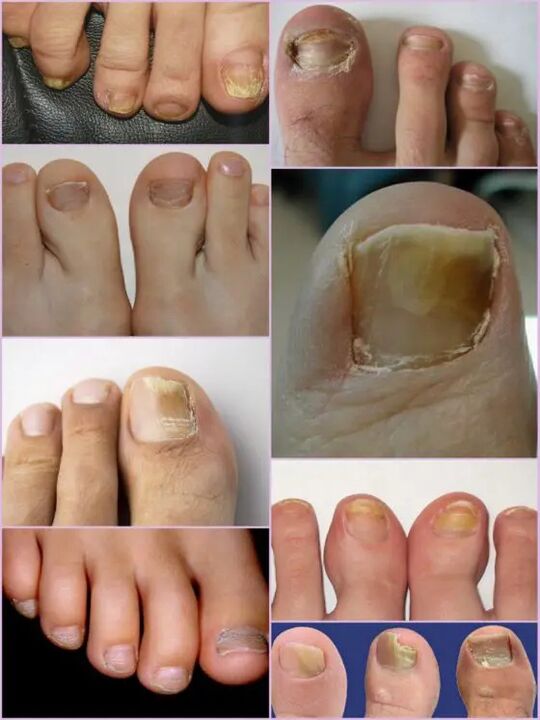 Types of nail fungi