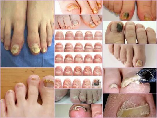 Types of onychomycosis