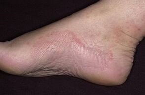 Mushroom damage of the foot