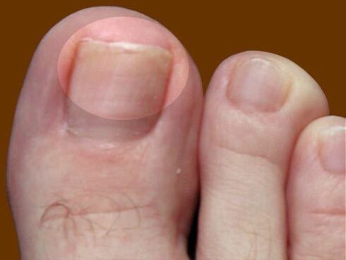The lesion of fungi