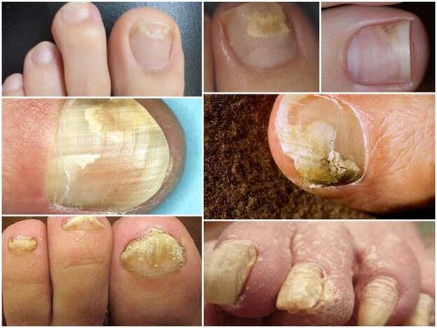 infection
