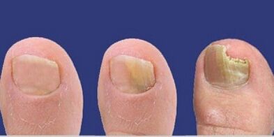 Nail fungi development stages
